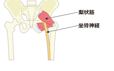 右お尻から脚の痛みを軽減するための食事法