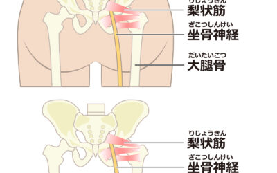 梨状筋症候群の真実：体の歪みが引き起こす痛みを解消する方法