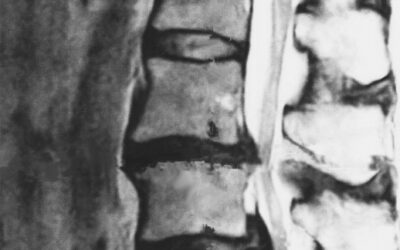 歩くと足がしびれる、休むと楽になる…それは「腰部脊柱管狭窄症」かもしれません